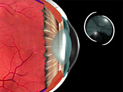 cataract removal and IOL implant